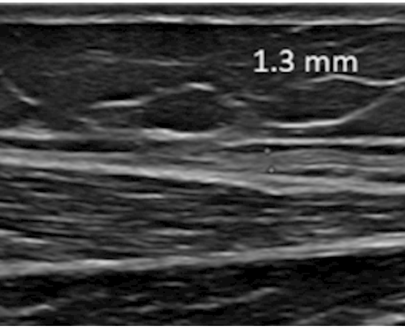 Sonographic imaging and assessment of the sural nerve